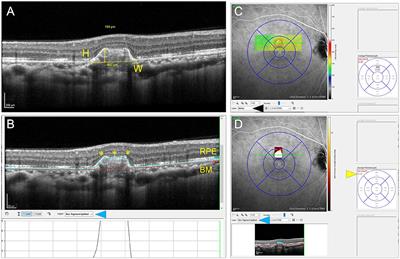 Optical Coherence Tomography Findings of Underlying Choroidal Neovascularization in Punctate Inner Choroidopathy